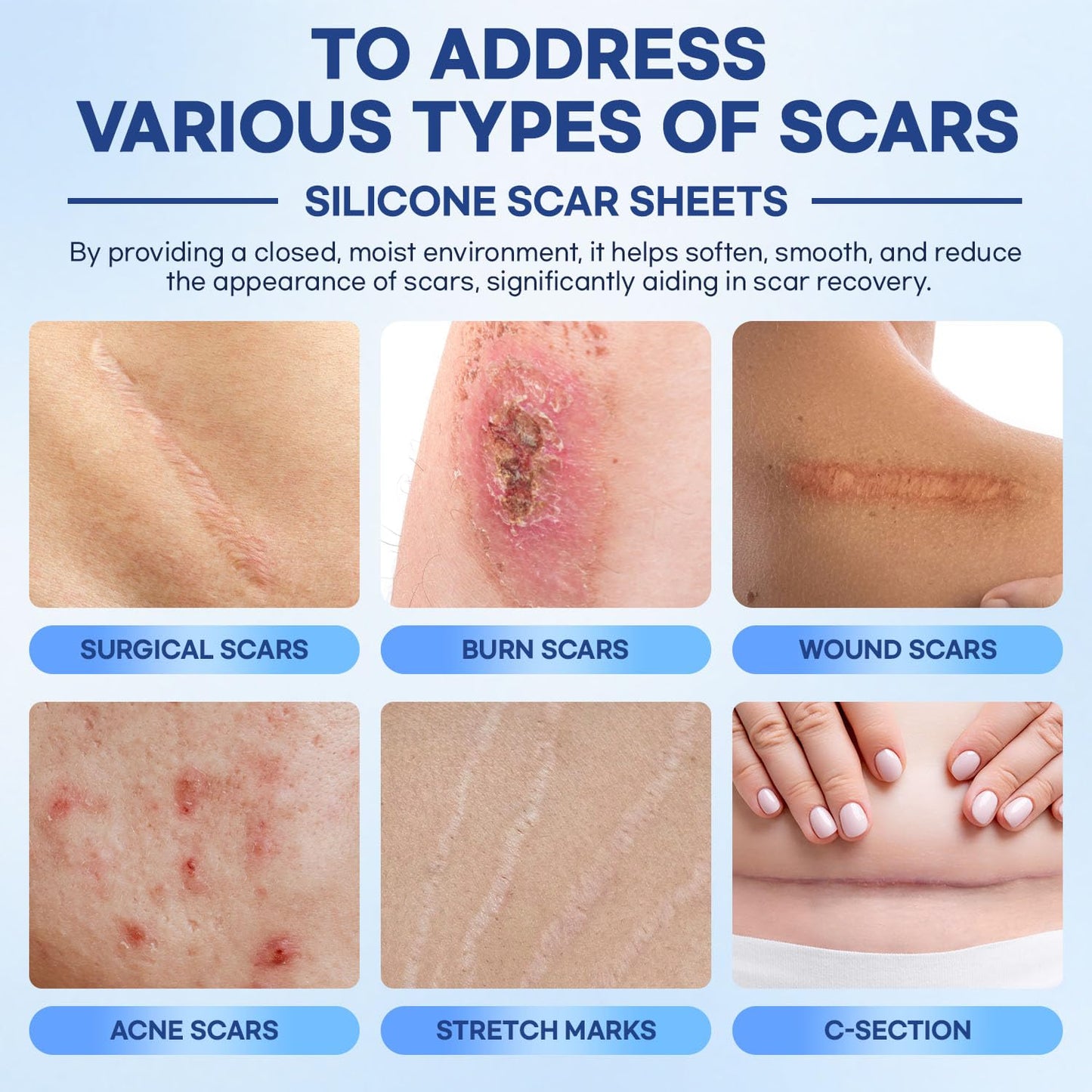 Aroamas Scar Silicone Scar Sheets