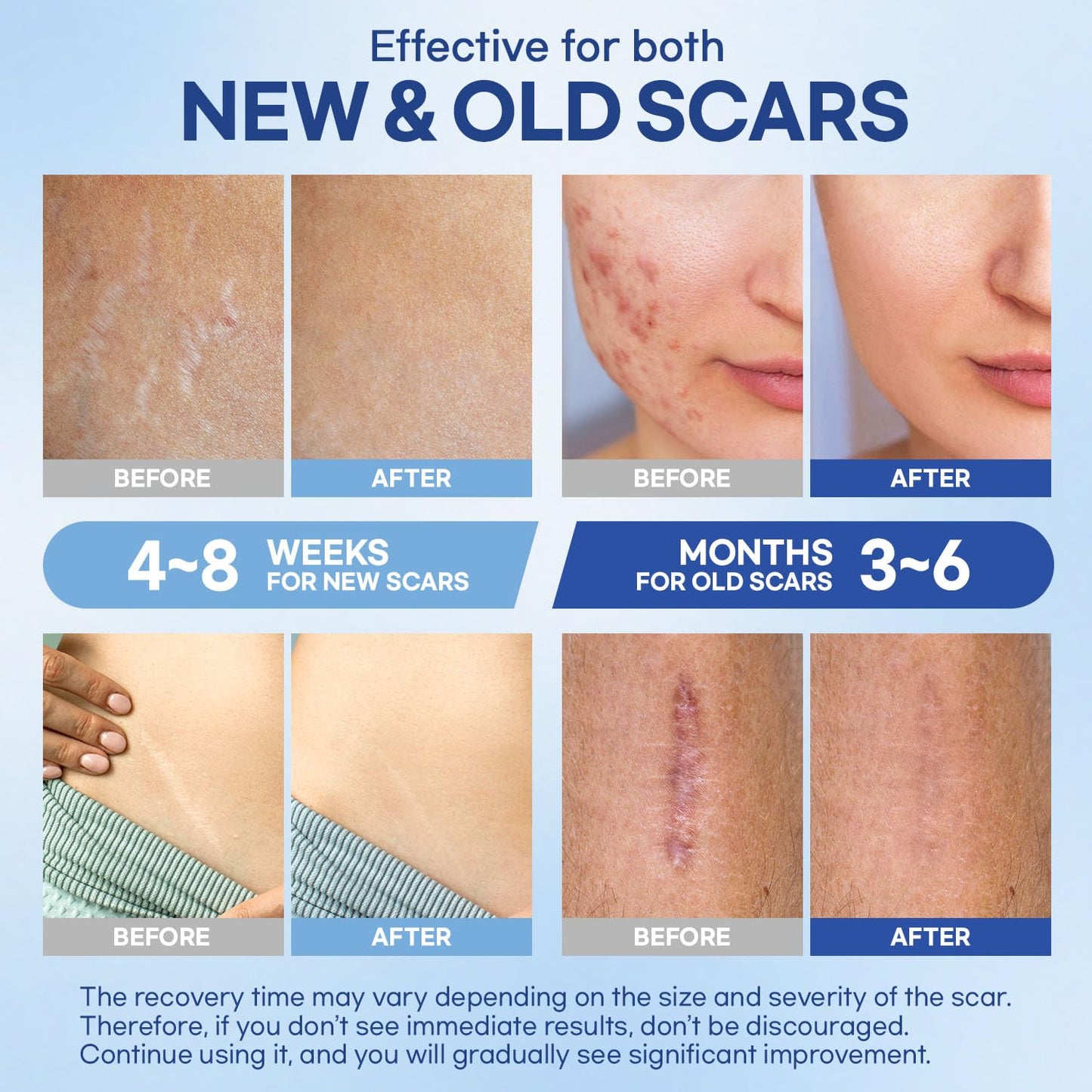 Aroamas Scar Silicone Scar Sheets