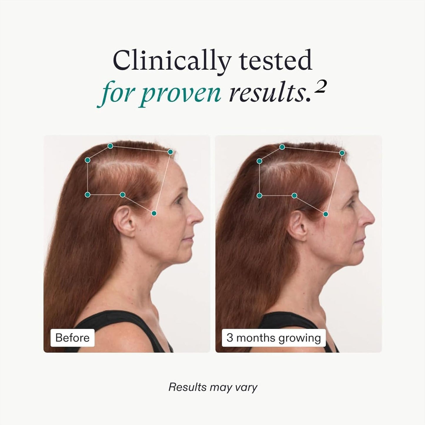 Nutrafol Balance Hair Growth Supplements, Ages FortyFive and Up